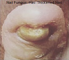 Thickened nail solutions