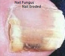 Toe nail fungus treatment
