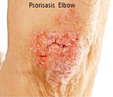 psoriasis elbow treatment