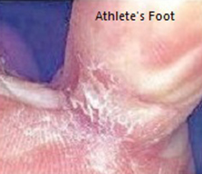 Athletes Foot treatment