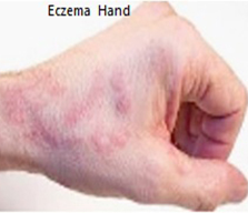 Eczema hand treatment