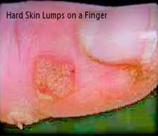 Finger Hard Skin removal