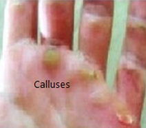 Calluses Corn removal