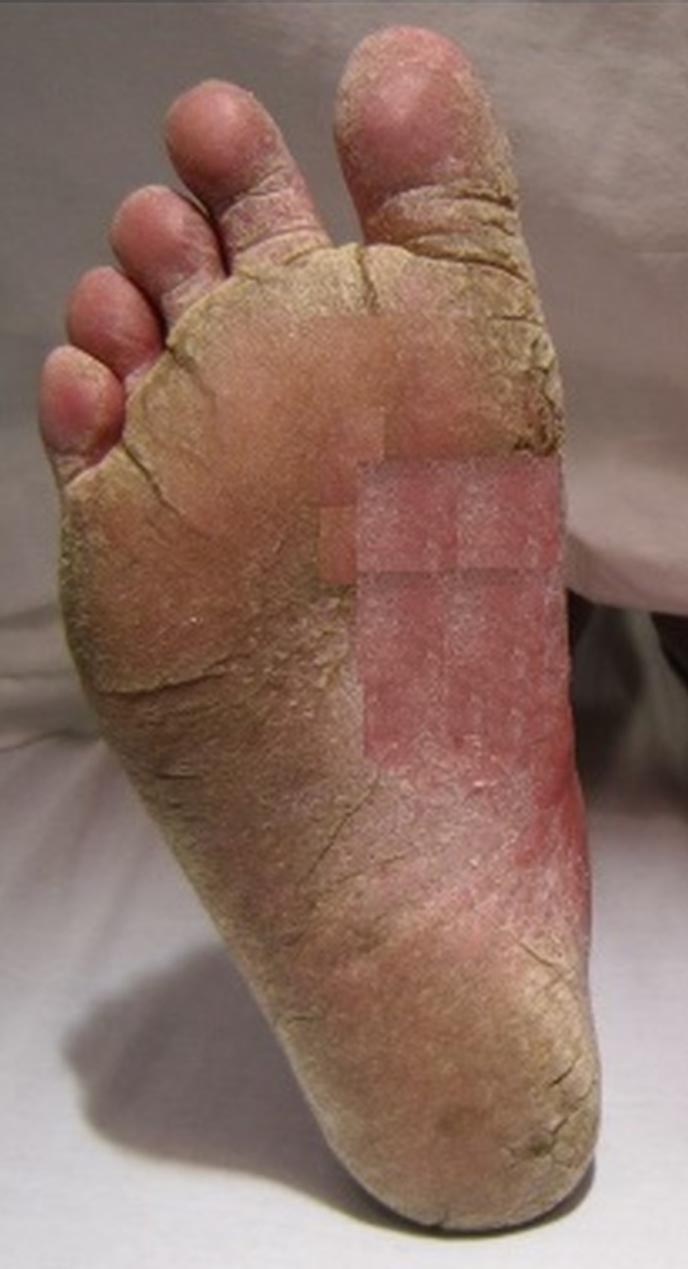 best way to remove hard skin from feet