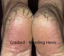 Cracked Heels Treatment