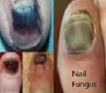 Fingernail Fungus Treatment