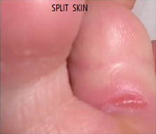 Split Skin treatment